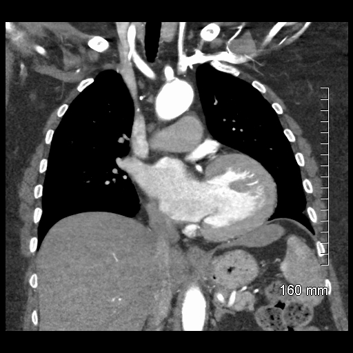 Aberrant right subclavian artery stenosis (Radiopaedia 52656-58670 B 43).jpg