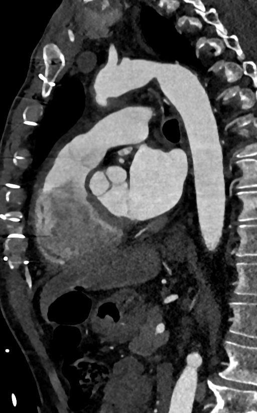 Accessory left atrial appendage (Radiopaedia 81987-95968 Sagittal C+ arterial phase 68).jpg