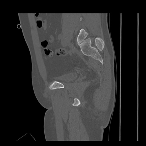 Acetabular and ilial fractures (Radiopaedia 59084-66378 Sagittal bone window 40).jpg