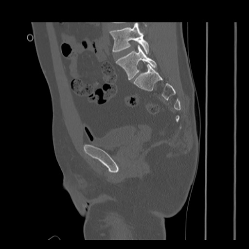 File:Acetabular and ilial fractures (Radiopaedia 59084-66378 Sagittal bone window 46).jpg