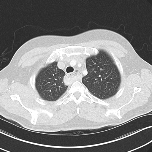 Achalasia of the cardia (Radiopaedia 38497-40595 Axial lung window 13).png