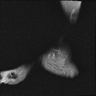 File:Achilles tendon tear (Radiopaedia 77615-89819 Sagittal PD fat sat 1).jpg