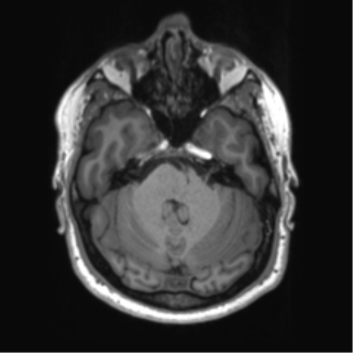 File:Achondroplasia (Radiopaedia 65109-74105 Axial T1 41).png