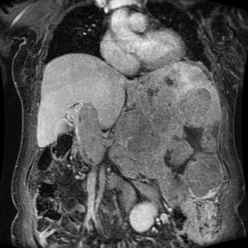 Acinar cell carcinoma of the pancreas (Radiopaedia 75442-86668 Coronal T1 C+ fat sat 115).jpg