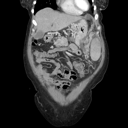 Acinar cell carcinoma of the pancreas (Radiopaedia 75442-86669 Coronal C+ portal venous phase 32).jpg