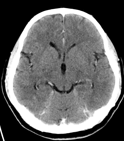 File:Acoustic schwannoma (Radiopaedia 33045-34065 Axial C+ delayed 11).png