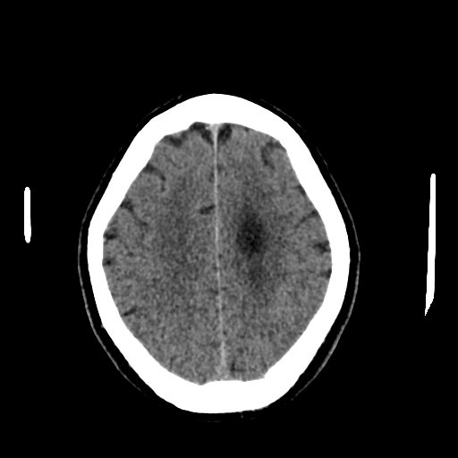File:Acoustic schwannoma (Radiopaedia 55729-62280 Axial non-contrast 26).png