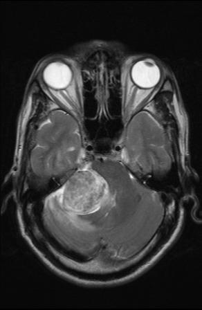 File:Acoustic schwannoma - probable (Radiopaedia 20386-20292 Axial T2 6).jpg