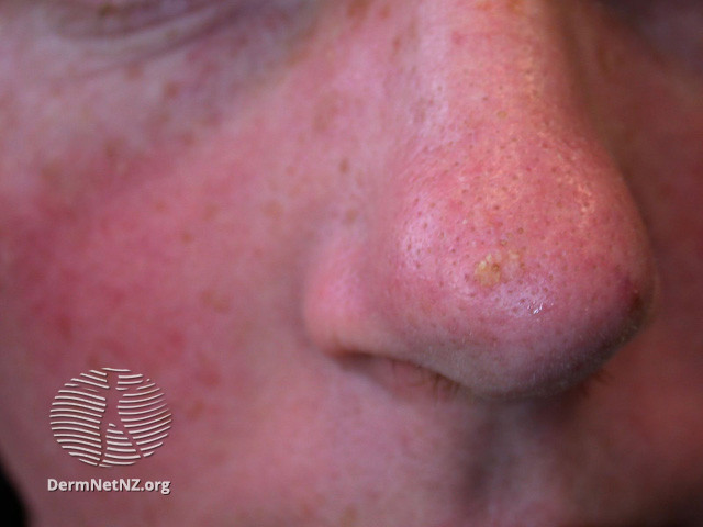 Actinic Keratoses affecting the face (DermNet NZ lesions-ak-face-431).jpg