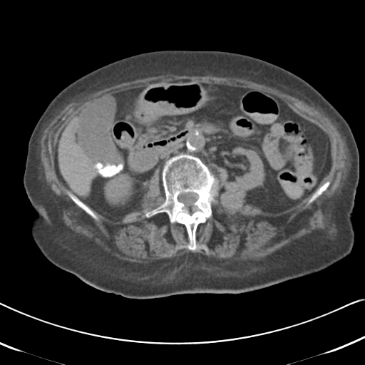 File:Active bleeding from duodenal ulcer with embolization (Radiopaedia 34216-35481 Axial non-contrast 28).png