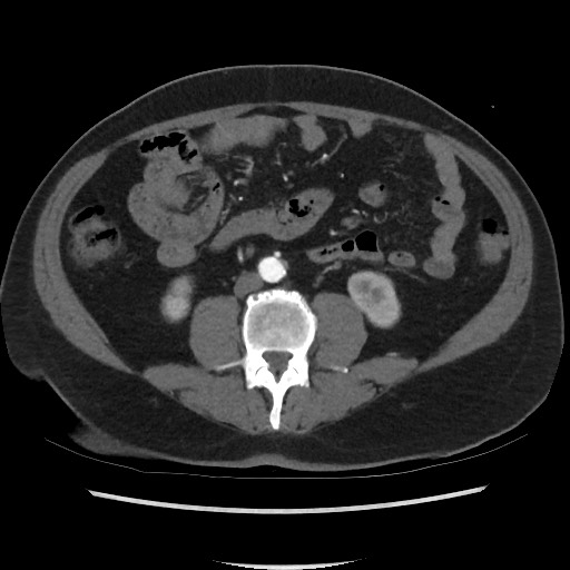 File:Active colonic bleed on CT (Radiopaedia 49765-55025 Axial C+ arterial phase 45).jpg