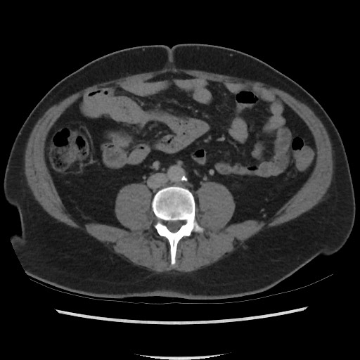 File:Active colonic bleed on CT (Radiopaedia 49765-55025 Axial C+ delayed 48).jpg