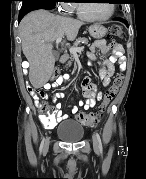 Active lower gastrointestinal bleeding - diverticular (Radiopaedia 61203-69106 Coronal C+ portal venous phase 52).jpg