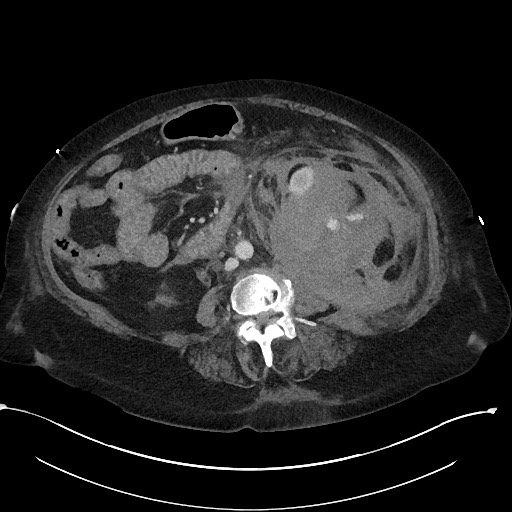 File:Active renal extravasation with large subcapsular and retroperitoneal hemorrhage (Radiopaedia 60975-68796 Axial 237).jpg
