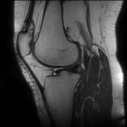 Acute-on-chronic transient lateral patellar dislocation with trochlear dysplasia (Radiopaedia 84099-99349 Sagittal PD 99).jpg
