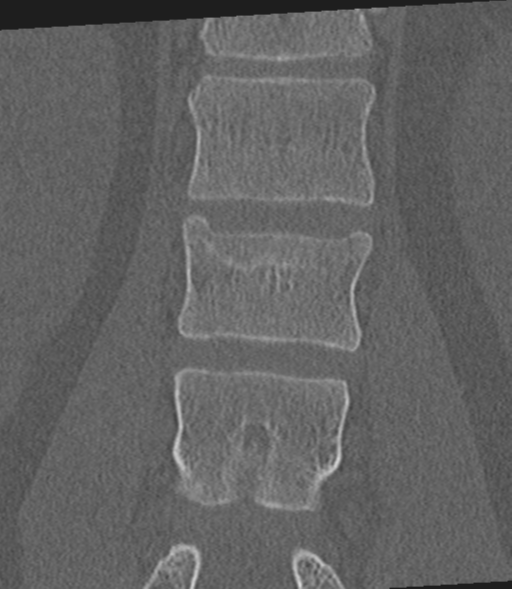 Acute L1 burst compression fracture (Radiopaedia 34430-35755 Coronal bone window 31).png