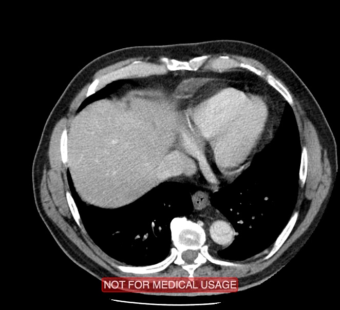 Acute aortic dissection - Stanford type A (Radiopaedia 40661-43285 Axial C+ portal venous phase 47).jpg