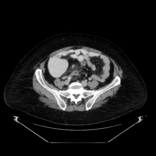 File:Acute appendicitis, heterotaxy syndrome (Radiopaedia 66884-76202 Axial 30).jpg