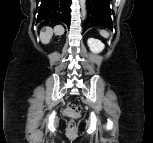 Acute appendicitis, heterotaxy syndrome (Radiopaedia 66884-76202 Coronal C+ portal venous phase 92).jpg