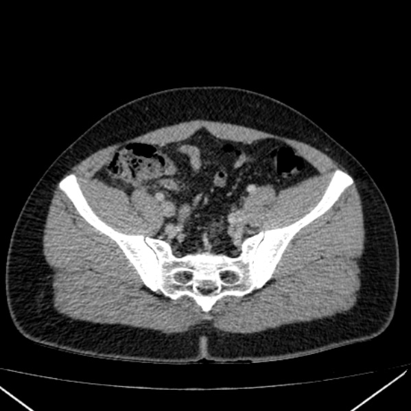 Acute appendicitis (Radiopaedia 38255-40270 Axial C+ portal venous phase 86).jpg