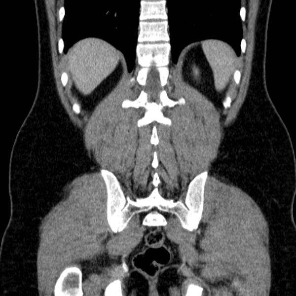 Acute appendicitis (Radiopaedia 38255-40270 Coronal C+ portal venous phase 69).jpg