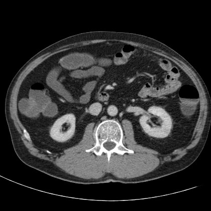 Acute appendicitis (Radiopaedia 66513-75790 Axial C+ portal venous phase 31).jpg
