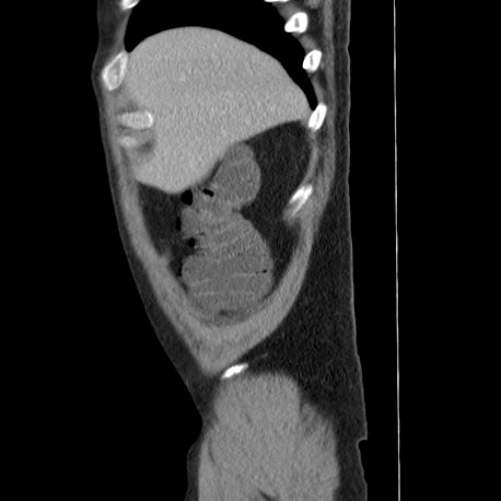 Acute appendicitis (Radiopaedia 66513-75790 Sagittal C+ portal venous phase 12).jpg