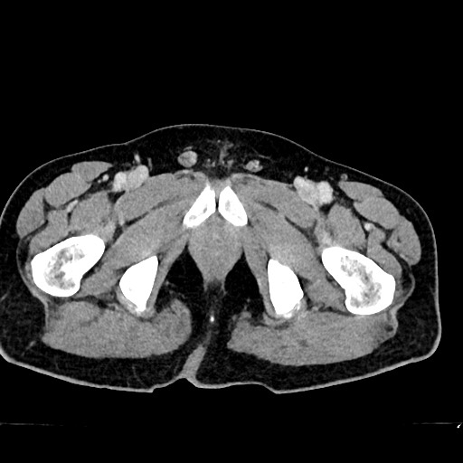Acute appendicitis (Radiopaedia 77016-88960 Axial C+ portal venous phase 148).jpg