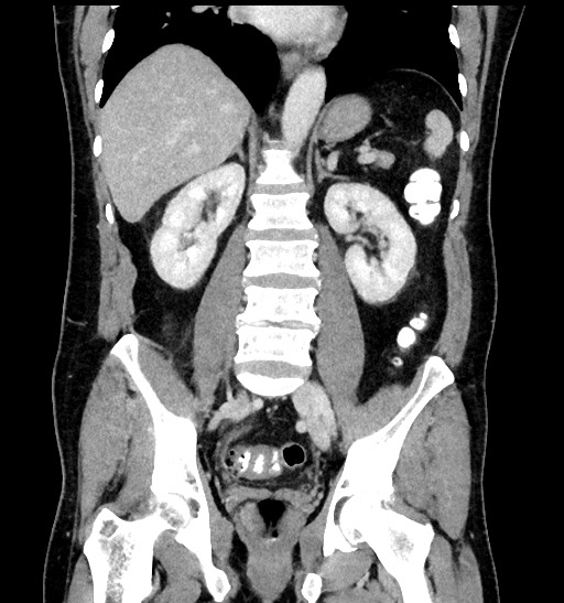 Acute appendicitis (Radiopaedia 77016-88960 Coronal C+ portal venous phase 62).jpg