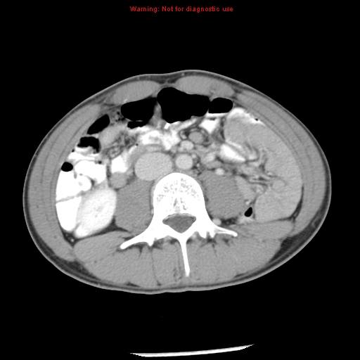 Acute appendicitis (Radiopaedia 8195-9045 Axial C+ portal venous phase 39).jpg