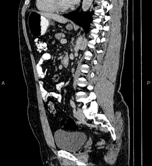 Acute appendicitis (Radiopaedia 84780-100240 Sagittal C+ portal venous phase 61).jpg