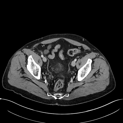 Acute appendicitis - large appendicoliths (Radiopaedia 61805-69820 Axial C+ portal venous phase 112).jpg