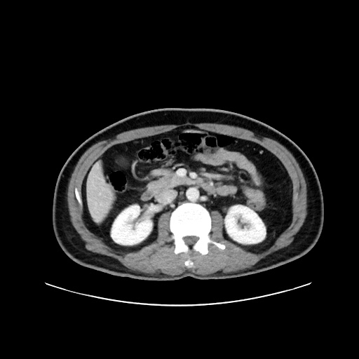 File:Acute appendicitis and COVID 19 pneumonia (Radiopaedia 76604-88380 Axial C+ portal venous phase 33).jpg