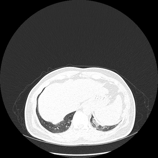 Acute appendicitis and COVID 19 pneumonia (Radiopaedia 76604-88380 Axial lung window 49).jpg