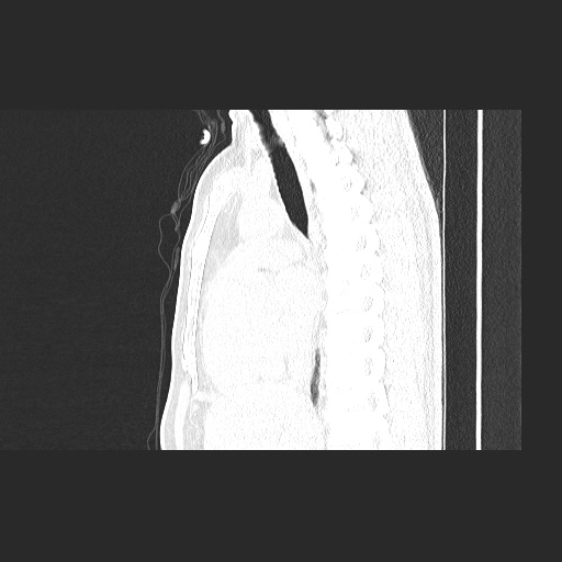 Acute appendicitis and COVID 19 pneumonia (Radiopaedia 76604-88380 Sagittal lung window 47).jpg