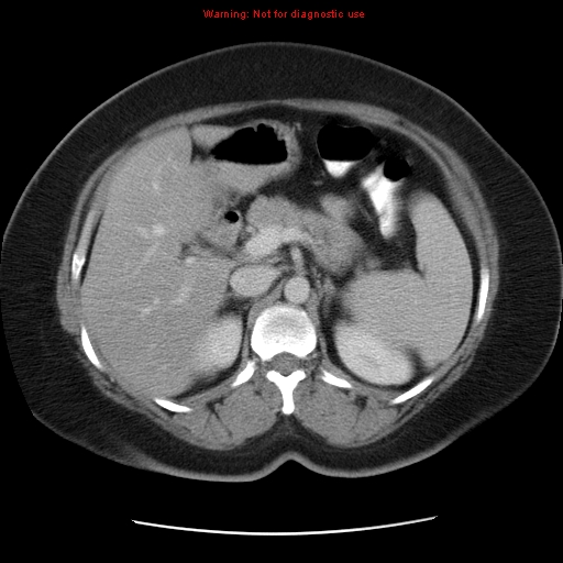 Acute appendicitis complicated by ovarian vein thrombophlebitis (Radiopaedia 16172-15851 Axial C+ portal venous phase 33).jpg