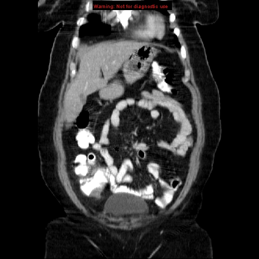 File:Acute appendicitis complicated by ovarian vein thrombophlebitis (Radiopaedia 16172-15851 Coronal C+ portal venous phase 24).jpg