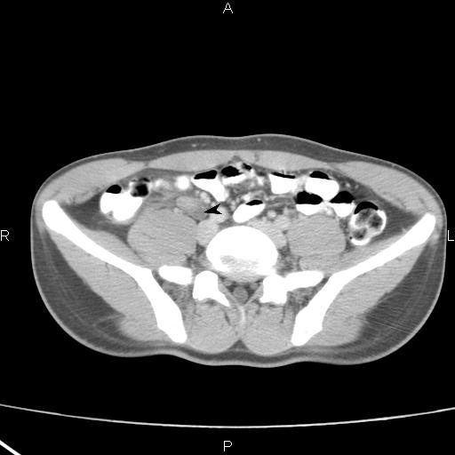 File:Acute appendicitis with CT arrowhead sign (Radiopaedia 21474-21411 E 1).jpg