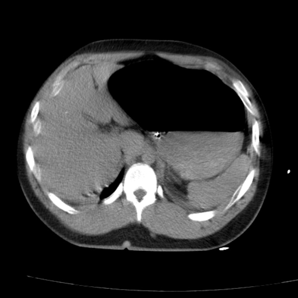 Acute aspiration pneumonitis (Radiopaedia 33605-34703 Axial non-contrast 80).jpg