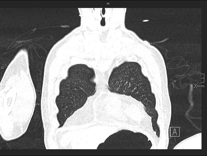 File:Acute aspiration pneumonitis (Radiopaedia 55642-62166 Coronal lung window 15).jpg