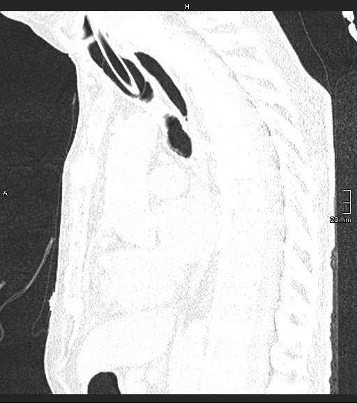 Acute aspiration pneumonitis (Radiopaedia 55642-62166 Sagittal lung window 76).jpg