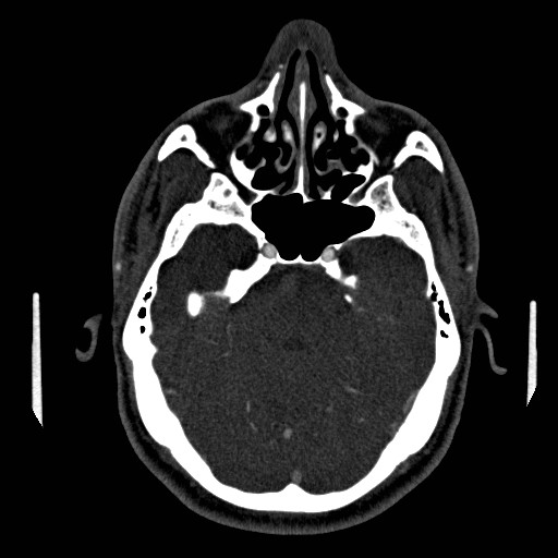 Acute basilar artery occlusion (Radiopaedia 43582-46985 Axial C+ arterial phase 58).jpg