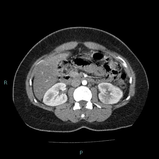 File:Acute bilateral pyelonephritis (Radiopaedia 37146-38881 Axial C+ arterial phase 84).jpg