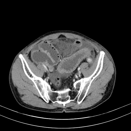 Acute bowel ischemia (Radiopaedia 87695-104114 Axial C+ portal venous phase 68).jpg