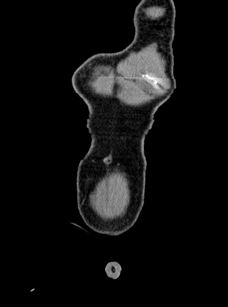 Acute bowel ischemia (Radiopaedia 87695-104114 Coronal C+ portal venous phase 61).jpg
