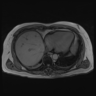 Acute cholecystitis (Radiopaedia 72392-82923 Axial T1 out-of-phase 22).jpg