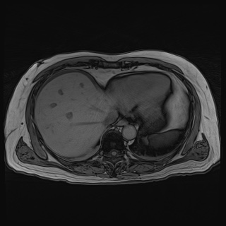 File:Acute cholecystitis (Radiopaedia 72392-82923 Axial T1 out-of-phase 25).jpg