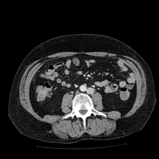 Acute cholecystitis and incidental left sided IVC (Radiopaedia 49352-54459 Axial C+ portal venous phase 86).jpg