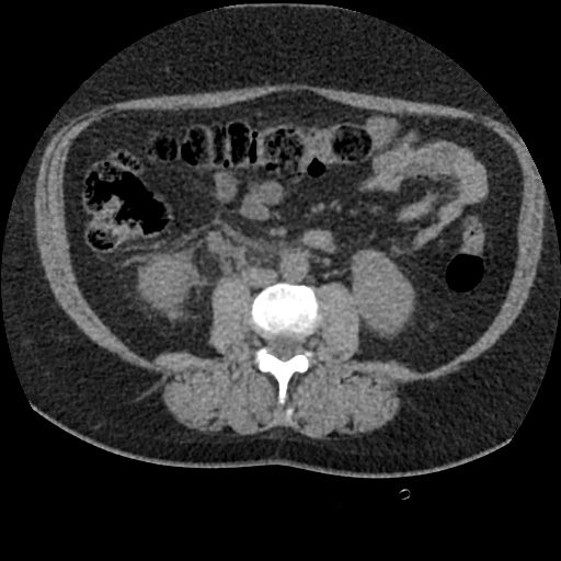 Acute cholecystitis and ureteric colic (Radiopaedia 42330-45444 Axial prone 54).jpg