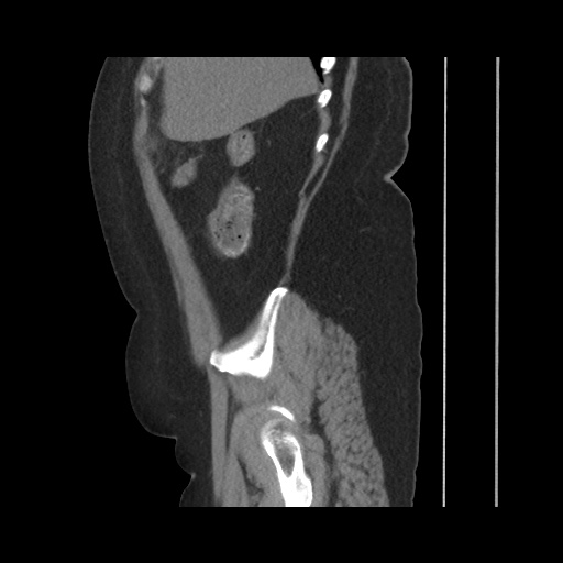 Acute cholecystitis with tensile fundus sign (Radiopaedia 71394-81723 Sagittal non-contrast 48).jpg